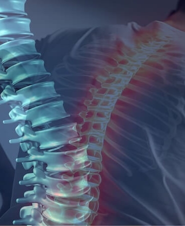 Omurga Kırığı: Modern ve Klasik Cerrahi Tedavi Yöntemleri