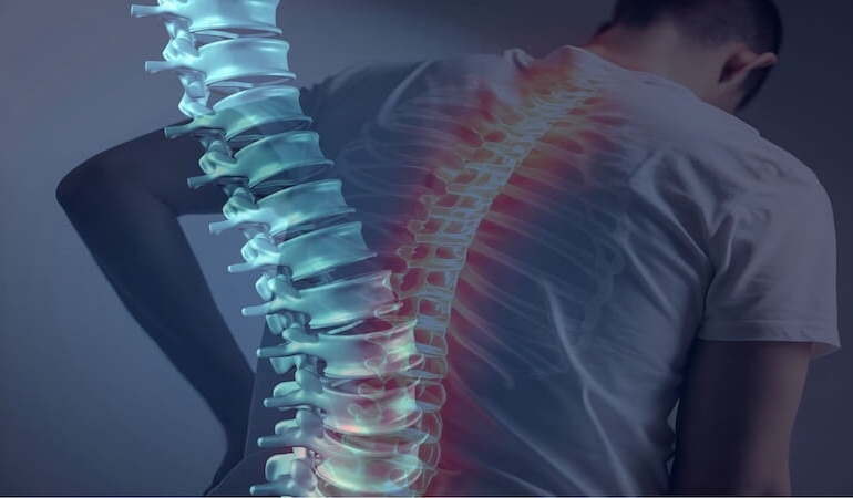 Omurga Kırığı: Modern ve Klasik Cerrahi Tedavi Yöntemleri